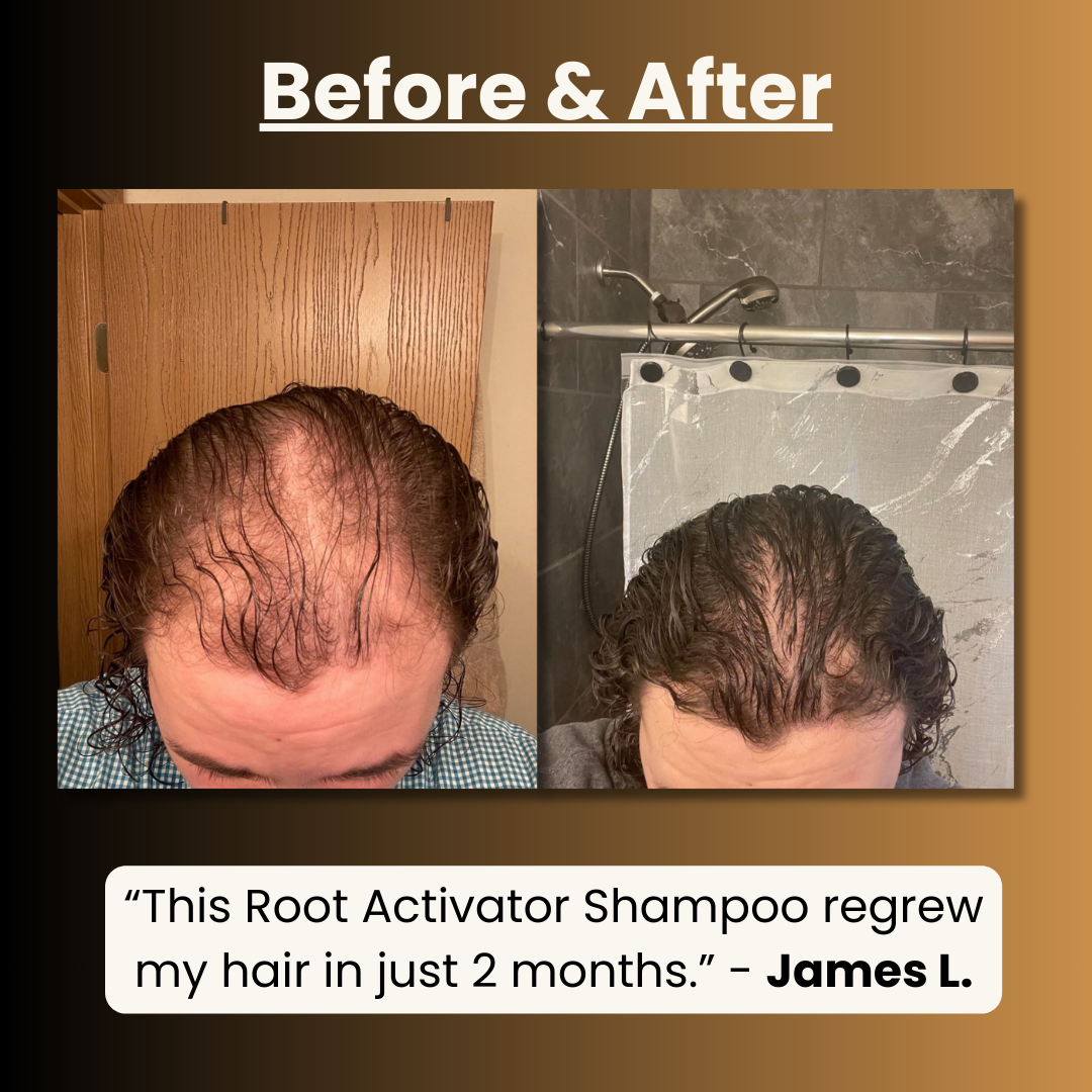 Root Activator Shampoo - Regrow Your Hair Back Using Plain Science*